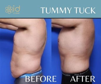 Before and after tummy tuck results at ID Clinic Bangkok – visible abdominal contour improvement