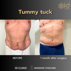 Before and after tummy tuck results at ID Clinic Bangkok – flatter abdomen after 1 month