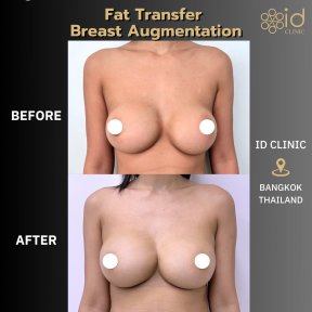 Before and after fat transfer breast augmentation results at ID Clinic Bangkok, natural look