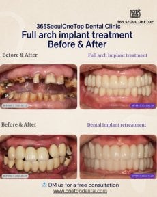 Before and after full arch dental implant results at 365SeoulOneTop365 Dental Clinic