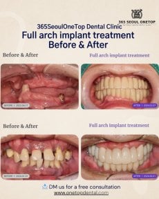 Результати до і після повної імплантації зубів у 365SeoulOneTop365 Dental Clinic
