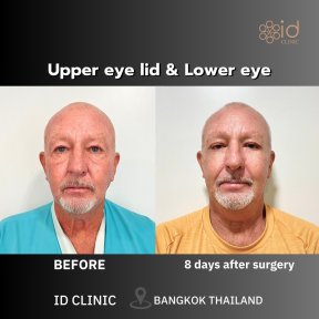 Before and after upper and lower eyelid surgery results at ID Clinic Bangkok, 8 days post-op