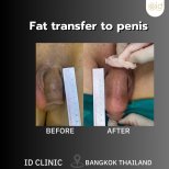 Before and after fat transfer to penis at ID Clinic Bangkok, visible girth enhancement result