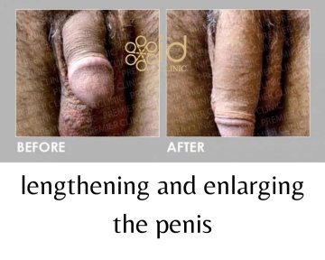 Before and after surgical penile lengthening results at ID Clinic Bangkok, visible size increase