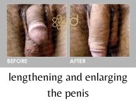 Before and after surgical penile lengthening results at ID Clinic Bangkok, visible size increase