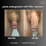 Before and after penis enlargement with filler injection results at ID Clinic Bangkok