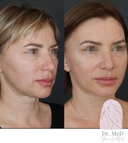 Before and after liposuction result at Dr. MED, improved facial contour and jawline definition