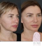 Before and after liposuction result at Dr. MED, improved facial contour and jawline definition