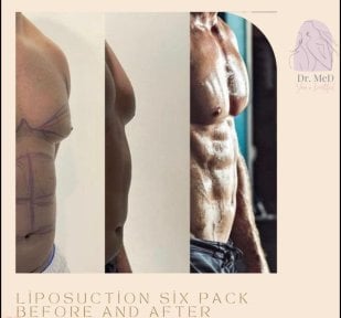 Before and after liposuction six pack results at Dr. MED – defined abs contour improvement