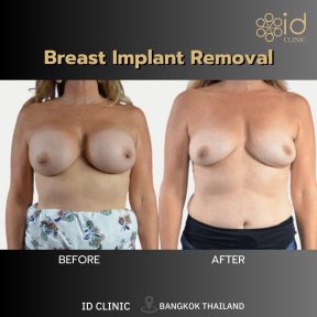 before-after photo mastopexy-breast-lift-contour-plastics