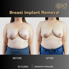 before-after photo mastopexy-breast-lift-contour-plastics