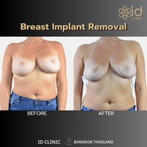 before-after photo mastopexy-breast-lift-contour-plastics