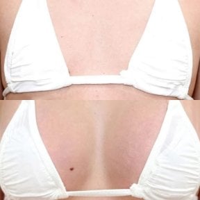 Before and after breast augmentation results at Somchai Clinic, enhanced breast volume