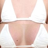Before and after breast augmentation results at Somchai Clinic, enhanced breast volume