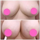 Before and after breast augmentation results at Somchai Clinic, enhanced breast volume