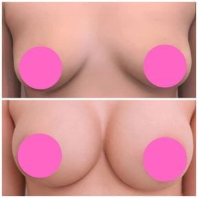 Before and after breast augmentation results at Somchai Clinic, enhanced breast volume