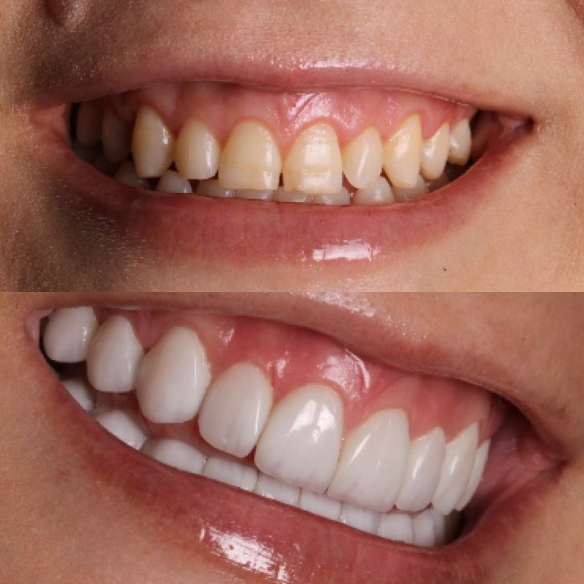 Resultados antes y después de carillas de composite en Clínica Zago, sonrisa mejorada