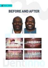 Before and after dental implant results at Dentinno Dental Clinic – restored smile transformation