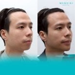 Before and after facial masculinization surgery results at Wansiri Hospital, jawline enhancement