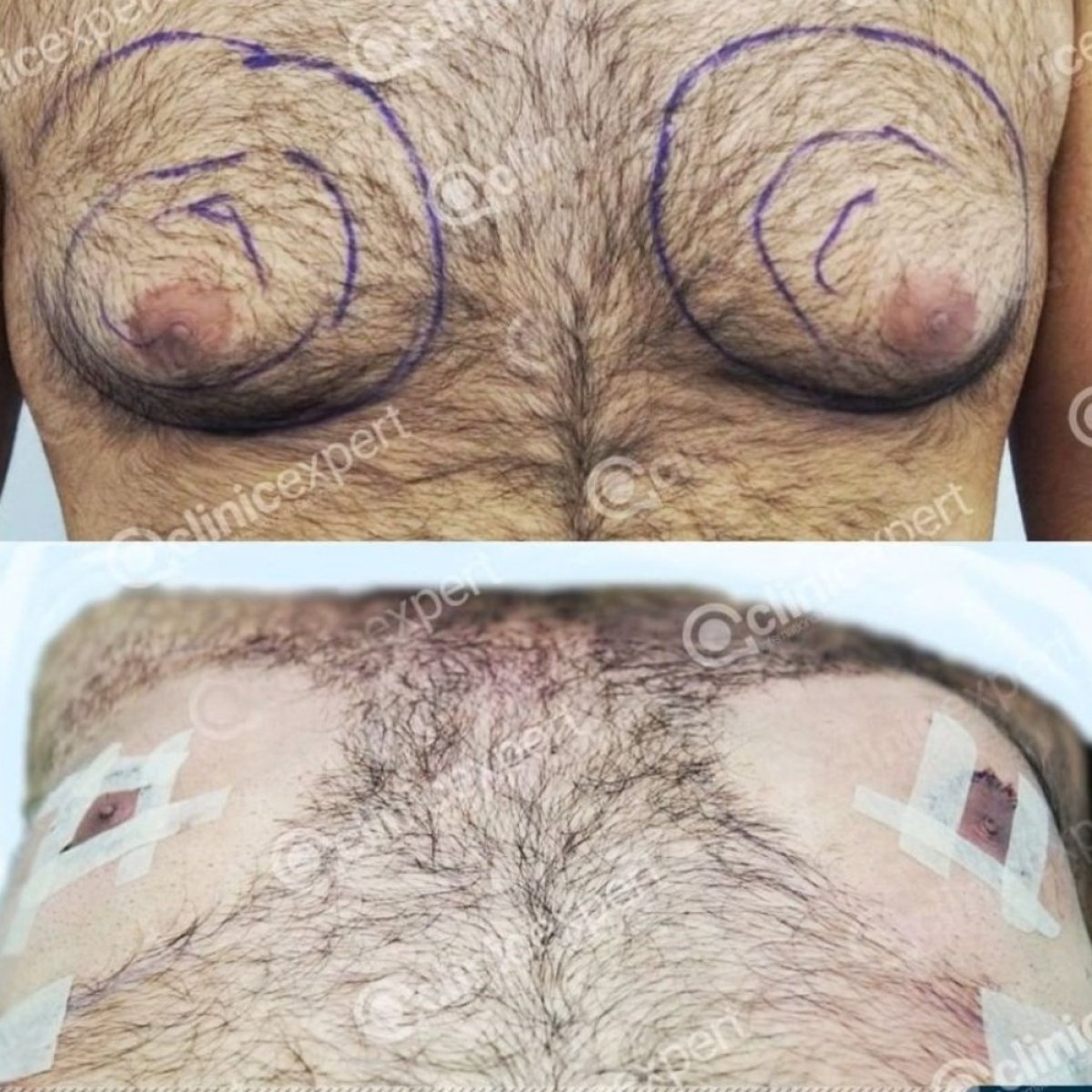 Antes y después de liposucción por ginecomastia en CE International Hospital, resultado masculino