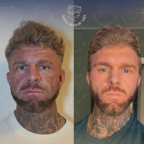 Vorher-nachher-Ergebnis der Gesichtsfetttransplantation in der Dr. Safa Manav Klinik