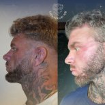 Vorher-nachher-Ergebnis der Gesichtsfetttransplantation in der Dr. Safa Manav Klinik