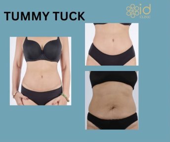 before-after photo abdominoplasty