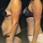 Liposuktion Vorher-Nachher-Ergebnis bei Memorial Göztepe Hospital, verbesserte Bauchkontur