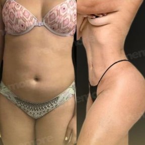 Vorher-nachher-Ergebnis 360°-Liposuktion bei Memorial Göztepe Hospital, Körperkontur verbessert