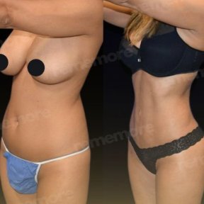 Vorher-nachher-Ergebnis 360°-Liposuktion bei Memorial Göztepe Hospital, verbesserte Körperform