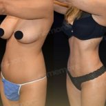 Vorher-nachher-Ergebnis 360°-Liposuktion bei Memorial Göztepe Hospital, verbesserte Körperform