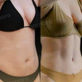 Vorher-nachher-Ergebnis 360-Liposuktion bei Memorial Göztepe Hospital, verbesserte Körperform