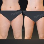Vorher-nachher-Ergebnis 360°-Liposuktion bei Memorial Göztepe Hospital, verbesserte Körperform