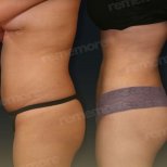 Vorher-nachher-Ergebnis 360°-Liposuktion bei Memorial Göztepe Hospital, verbesserte Körperform
