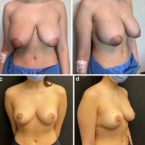 Before and after breast reduction results at Memorial Bahçelievler Hospital, improved contour