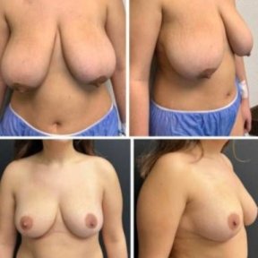 Before and after breast reduction results at Memorial Bahçelievler Hospital, improved contour