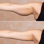 Результаты до и после брахиопластики в Dr. Alexandro Aguilera - Plastic Surgery