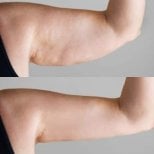 Результаты до и после подтяжки рук в Dr. Alexandro Aguilera - Plastic Surgery, улучшенный контур