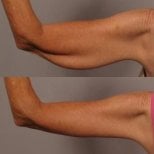 Результаты до и после подтяжки рук в Dr. Alexandro Aguilera - Plastic Surgery, улучшенный контур