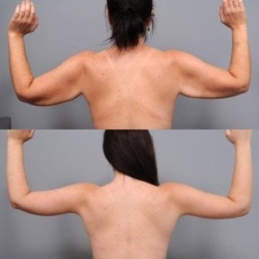 Результаты до и после подтяжки рук в Dr. Alexandro Aguilera - Plastic Surgery, улучшенный контур