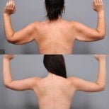 Результаты до и после подтяжки рук в Dr. Alexandro Aguilera - Plastic Surgery, улучшенный контур