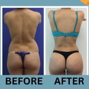 360 liposuction before and after results at ID Clinic Bangkok, improved body contour visible