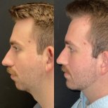 Vorher-nachher-Ergebnis Kinnaugmentation bei ID Clinic Bangkok, verbesserte Kinnlinie beim Mann