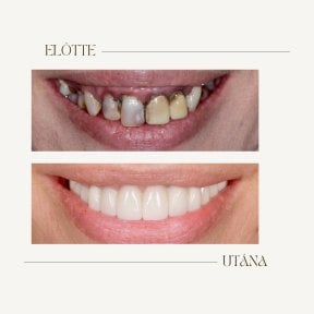 Before and after dental implant results at BMC Dental Klinik, restored smile transformation
