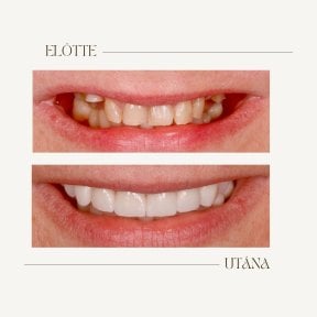 Before and after dental implant results at BMC Dental Klinik – restored smile transformation