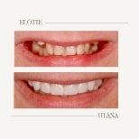 Before and after dental implant results at BMC Dental Klinik – restored smile transformation