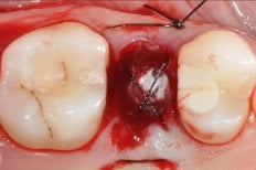 Dental bone regeneration result at SoftDentalCare Clinic, sutures visible after procedure