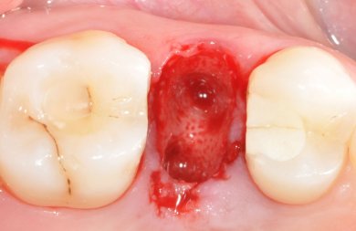 Régénération osseuse dentaire à SoftDentalCare Clinic, résultat visible de la zone traitée