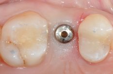 Dental bone regeneration result with implant placement at SoftDentalCare Clinic
