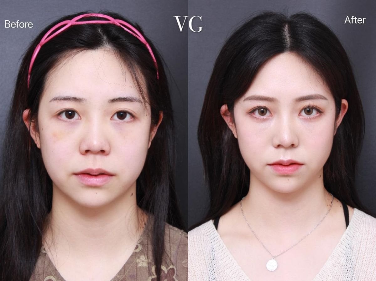نتائج قبل وبعد تجميل الأنف الآسيوي في VG Plastic Surgery، تحسين شكل الأنف